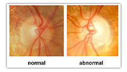 Glaucoma Eye Diagram