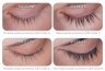 latisse before after
